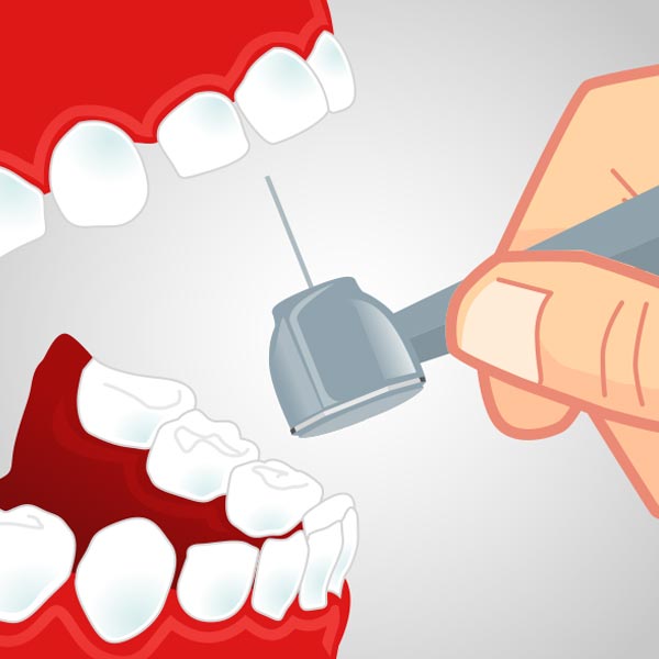 Desgaste oclusal del diente